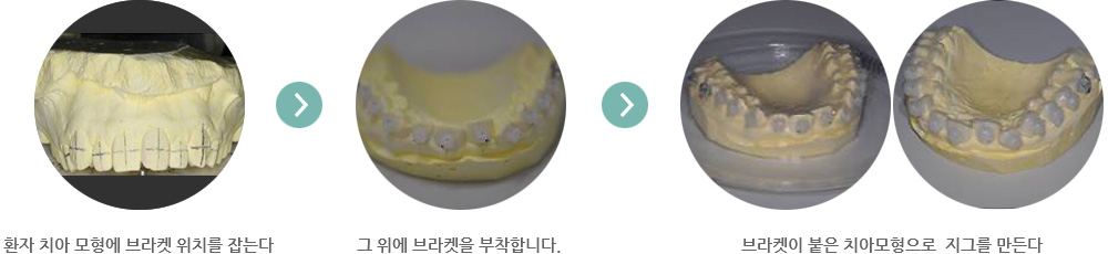 환자-치아모형에-브라켓-위치를-잡는다. 그-위에-브라켓을-부착합니다. 브라켓이-붙은-치아모형으로-지그를-만든다.